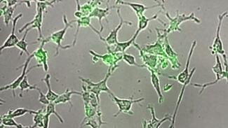 Die Antikörper sind grün markiert und bringen ausschließlich die bösartigen Zellen des Ewing-Sarkoms zum Leuchten. (Foto: Prof. Horacio Bach/Antibody Engineering Facility, University of British Columbia)  