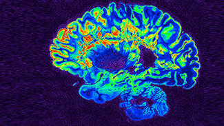 MRI-Scan eines Gehirns